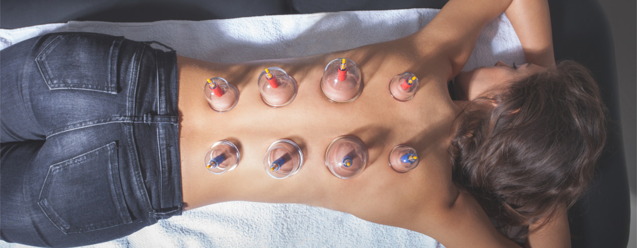 Cupping-Central-Nebraska-aurora-physical-therapy-aurora-ne