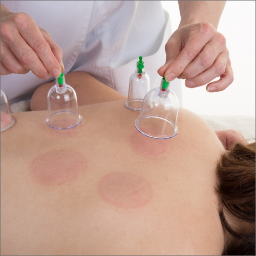 Cupping-Central-Nebraska-balance-mobility-lincoln-cancer-center-lincoln-ne
