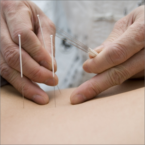 Dry-Needling-Central-Nebraska-balance-mobility-aquatic-grand-island-ne