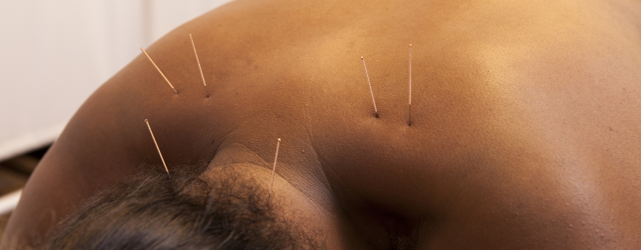 Dry-Needling-Central-Nebraska