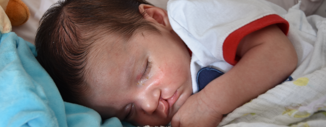 Cleft-Lip-Palate-Central-Nebraska