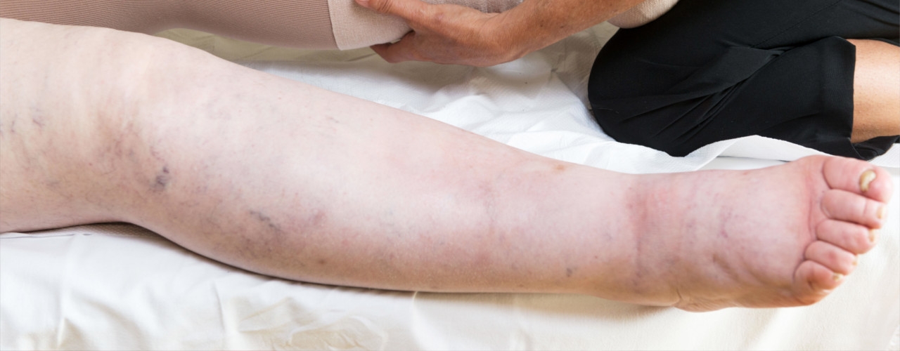 lymphedema-Womens-Health-and-Healing-Center-Grand-Island-NE