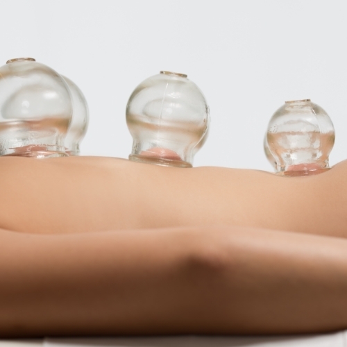 Cupping-St.-Elizabeth-Sport-and-Physical-Theapy-Lincoln-NE