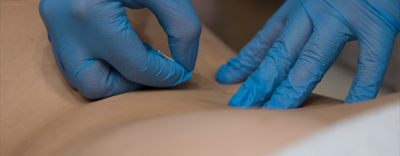 Dry-needling-central-nebraska-rehab-services-grand-island-ne