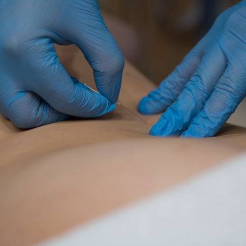 dry-needling-central-nebraska-rehab-services-grand-island-ne